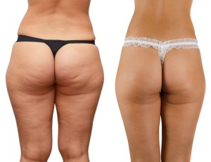 Cellulite-before-and-after-1000